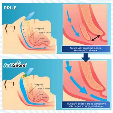 AntiSnore™ Kopča za Nos