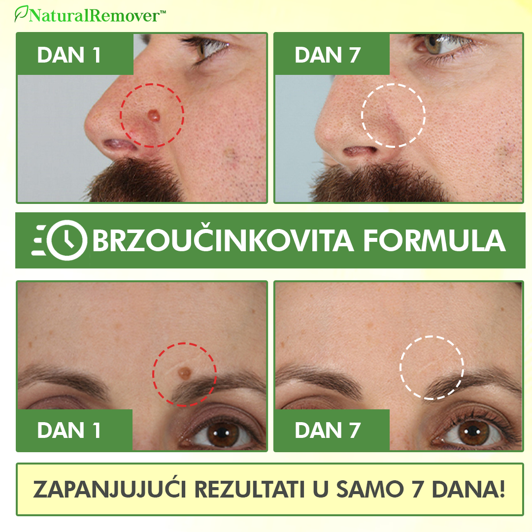 NaturalRemover™ Odstranjivač Kožnih Bradavica